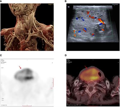 Giant functional parathyroid carcinoma: a case report and literature review